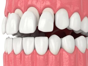 انواع روکش دندان و مقایسه آنها با دیگر روش‌های درمانی