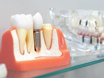 روش نگهداری و مراقبت از ایمپلنت دندان