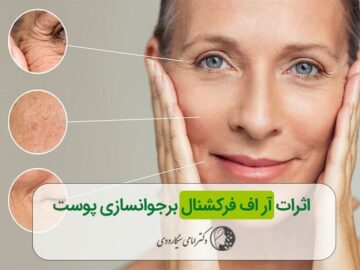 اثرات آر اف فرکشنال و سایر روش های درمانی بر جوانسازی پوست