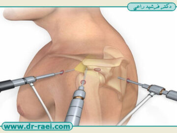 مزایای عمل آرتروسکوپی شانه نسبت به عمل باز