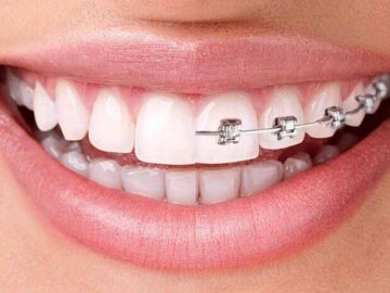 هزینه ارتودنسی فک بالا در سال ۱۴۰۲ چقدر است؟