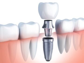 هزینه درمان های دندانپزشکی در ابتدای سال ۱۴۰۲