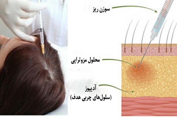 آموزش مزوتراپی مو