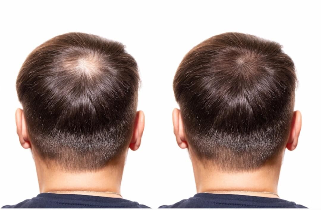 آموزش مزوتراپی مو