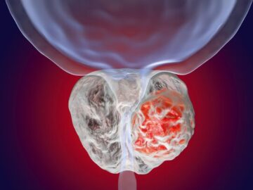 نحوه درمان اختلالات ادراری به علت بزرگی پروستات