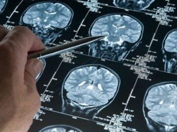 ایران به‌عنوان دومین کشور دنیا موفق به تولید داروی سکته مغزی شد